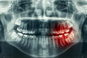 Dental Medical Malpractice Lawsuits