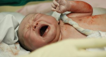 What is Erb’s Palsy? Do I have a Medical Malpractice Claim?