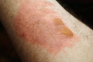 Challenges and Compensation Options after Ethylene Oxide Exposure in Trenton New Jersey